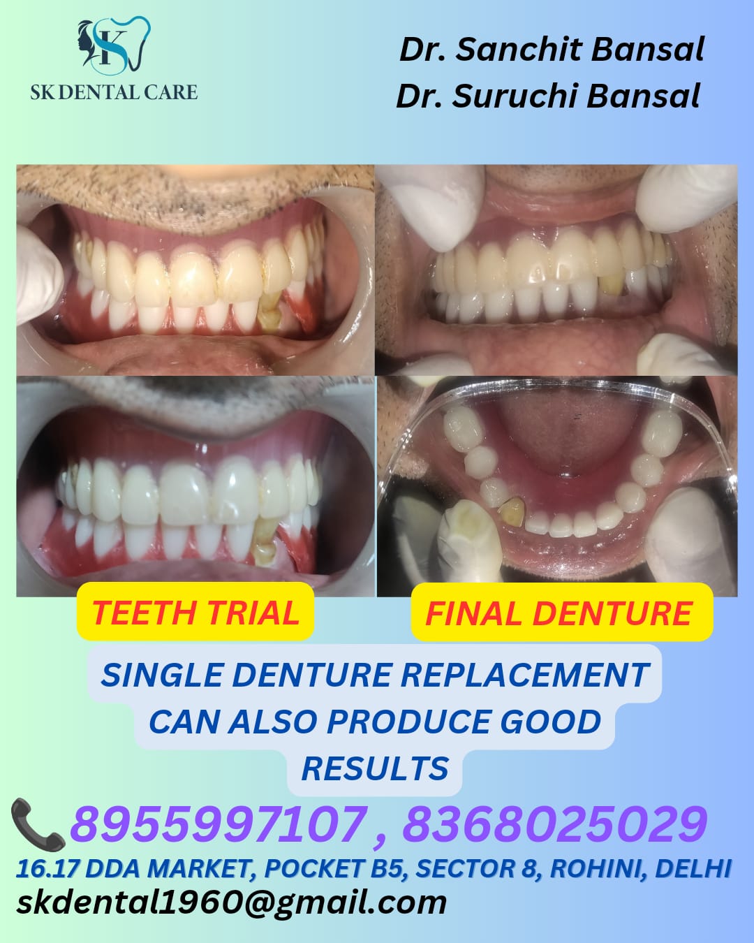 Single Denture Replacement